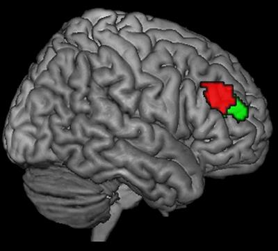 Differential Resting-State Connectivity Patterns of the Right Anterior and Posterior Dorsolateral Prefrontal Cortices (DLPFC) in Schizophrenia